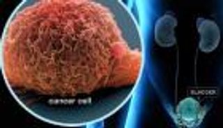 وداعا للمنظار.. عينة بول لتشخيص سرطان المثانة