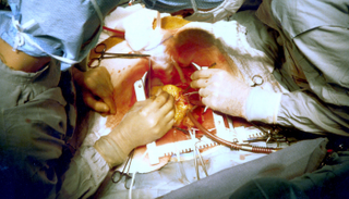 زراعة الأعضاء الحيوانية في جسم الإنسان باتت على بعد خطوة