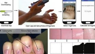 التطبيق يرصد بدقة علامات الأنيميا من خلال لون الجلد أسفل الأظافر