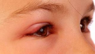 الوذمة الوعائية مرض وراثي نادر