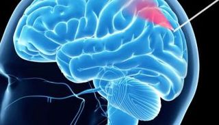 كاميرا بحجم شعرة لتصوير الأوعية الدموية أثناء جراحات المخ