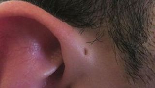 اكتشفه لأول مرة العالم فان هوسينجر عام 1864