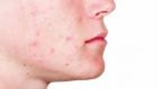 5 أشياء يخبرنا عنها حب الشباب