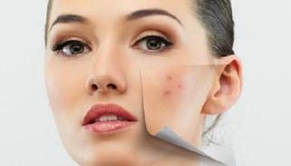 صودا الخبز تخلصك من آثار حب الشباب