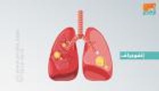 إنفوجراف.. اليوم العالمي للسُل حقائق وأرقام 