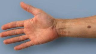 شامة تظهر على الجلد لتحذر من السرطان