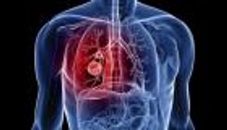 فشل تجربة استخدام عقارين معا في علاج سرطان الرئة