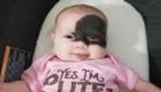 ولادة طفلة بوحمة كبيرة تثير مخاوف والديها