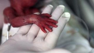 الابتسار أكبر سبب لوفاة الرضع حول العالم