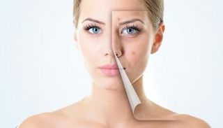 وصفات طبيعية للقضاء على حبوب البشرة الدهنية