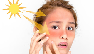 3 طرق بسيطة للتخلص من حروق الشمس