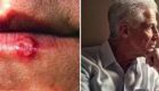 أدوية علاج الهربس تقلل من مخاطر الإصابة بألزهايمر