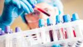 اختبار للدم يكشف خطر الوفاة بسرطان الأمعاء