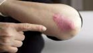 6 طرق طبيعية تساعدك على علاج الصدفية