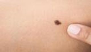 التعرض المفرط للشمس يزيد مخاطر الإصابة بورم الميلانوما