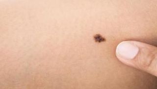 تغير لون الشامات الجلدية قد يكون مؤشرا على الميلانوما