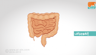 نصائح تجنبك الإصابة بسرطان الأمعاء