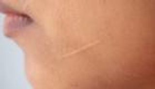 علاج جديد يخفي الندوب الناتجة عن الجراحة أو الإصابة