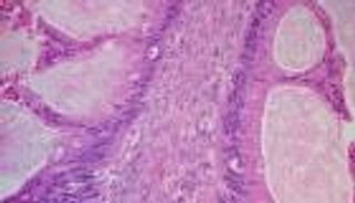 دواء جديد يحمل الأمل لمرضى سرطان المبيض