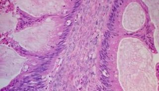 أكثر من 7 آلاف سيدة تصاب بسرطان المبيض سنويا في بريطانيا