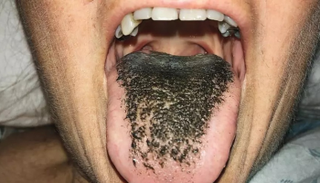 اللسان نما فوقه ما يشبه الشعر 