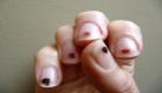 شكل الأظافر يساعد في تشخيص السرطان