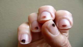 الأظافر تساعد في تشخيص السرطان