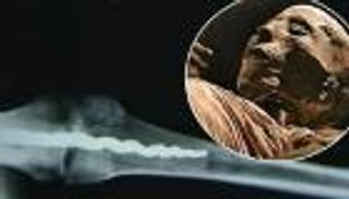 بالصور.. الفراعنة عرفوا تثبيت العظام بـ"المسمار الطبي"