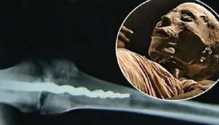 المسمار الطبي معروف منذ الفراعنة