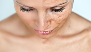 طرق طبيعية لعلاج البقع البنية والتخلص منها
