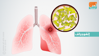 ثلث سكان العالم مصابون بالسل الكامن