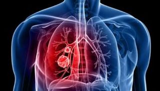 طرح عقار يبطئ تقدم مرض سرطان الرئة في أمريكا