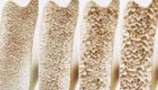 اكتشاف 301 عامل وراثي جديد خاص بهشاشة العظام