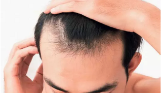 تساقط الشعر- صورة أرشيفية