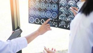 غياب "بروتين توم 1" يؤدي إلى تطور مرض ألزهايمر