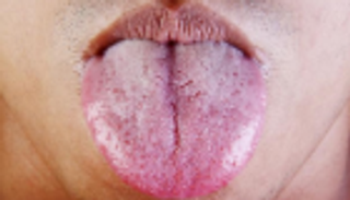 "لسان الفراولة" مؤشر للإصابة بأمراض معدية