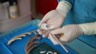 إعادة بناء أذن طفل إيطالي بتقنية الطابعات ثلاثية الأبعاد