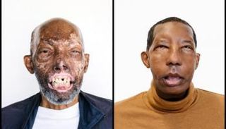 روبرت تشيلسيا أول أمريكي من أصل أفريقي يجري عملية زراعة وجه