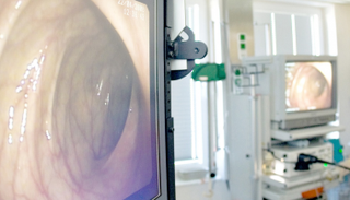 منظار المعدة يتيح اكتشاف ما يعرف بـ"البوليبات"