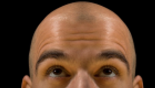 أول بنك شعر في العالم لمحاربة الصلع