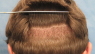 إيدز وكبد وبائي.. مخاطر زراعة الشعر في تركيا