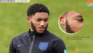 صورة.. خدش في وجه جوميز سبب استبعاد ستيرلنج من معسكر إنجلترا