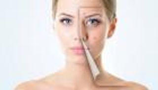 حب الشباب.. 5 أجزاء في الوجة تنذرك بمشاكل صحية