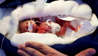 الطفل المبتسر هو المولود قبل اكتمال 36 أسبوعا من بداية الحمل - أرشيفية