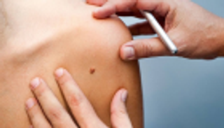 الشامة.. مؤشر محتمل للإصابة بسرطان الجلد