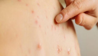 44 طفلا توفوا بسبب الحصبة في ساموا- أرشيفية