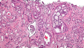 صورة مجهرية توضح سرطان البروستاتا