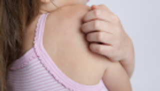 الصدفية تهاجم الأطفال أيضا