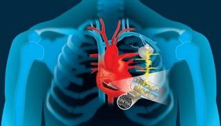 رقاقة تحول نبضات القلب إلى كهرباء لشحن الأجهزة المزروعة - أرشيفية