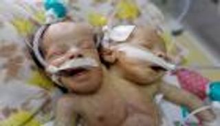 بالصور.. اشتراك توأم ملتصق في كبد وكليتين